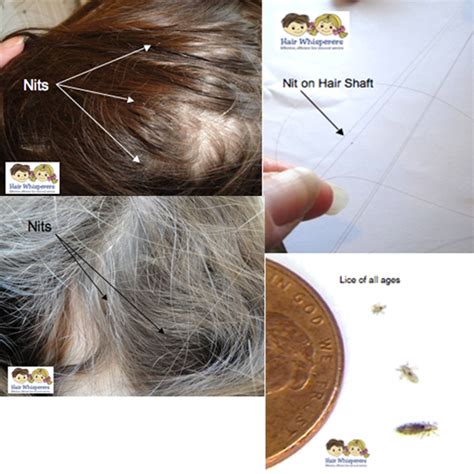 How to identify nits in hair