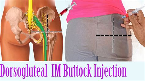 How to im injection in buttocks