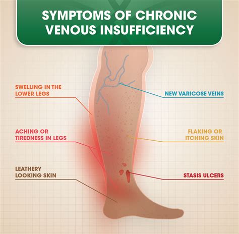 How to improve venous insufficiency in legs