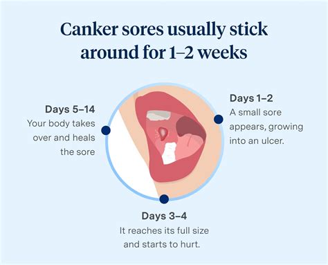 How to know canker sore is healing