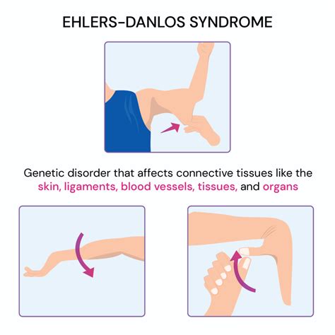 How to know if I have Ehlers-Danlos - Quora