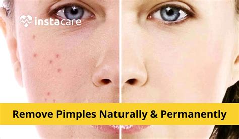How to lose pimples in a day