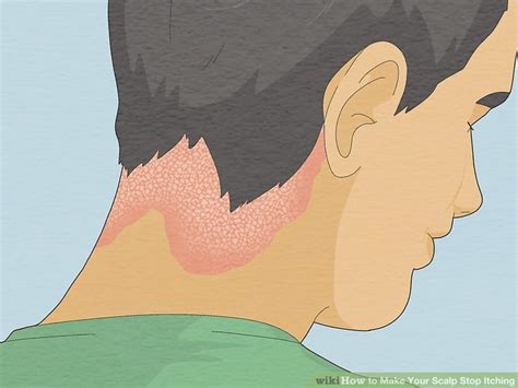 How to make my head stop itching