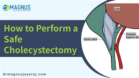 How to perform a safe cholecystectomy Doctors Blog