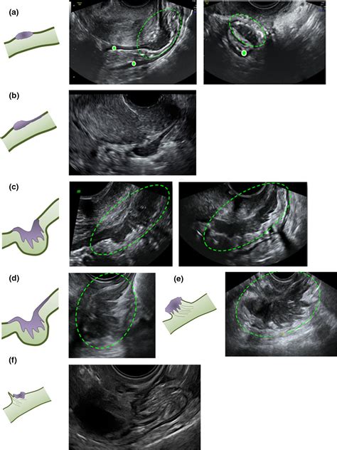 How to perform an ultrasound to diagnose endometriosis - Leonardi …