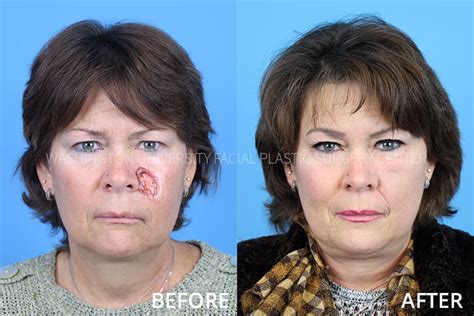 How to plastic surgery in face