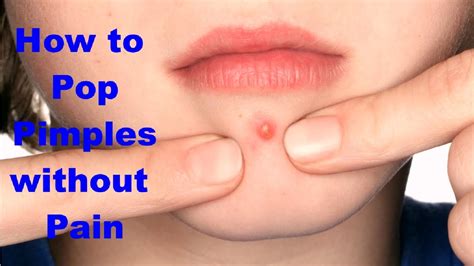 How to pop a pimple in nose
