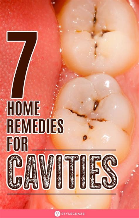 How to prevent and treat cavities at home Quick and easy cavity pain …