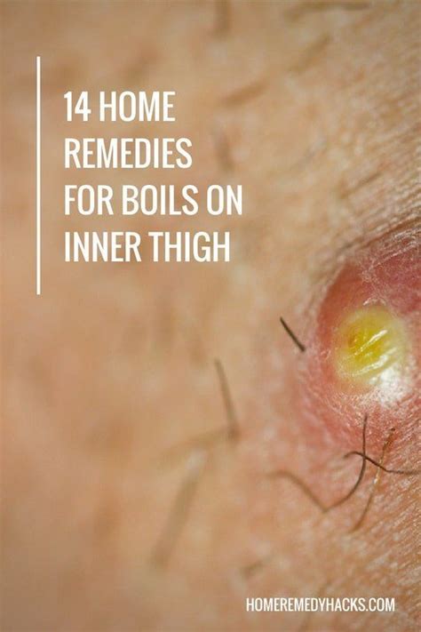 How to prevent boils on my inner thigh. The following tips can reduce the risk of developing boils on the thigh: use products designed to prevent chafing when playing sports or exercising; modify activities to lessen... 