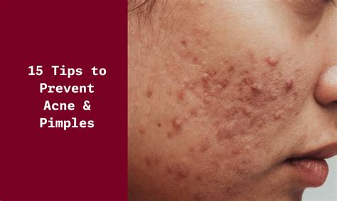 How to prevent pimples 15 tips to eliminate acne