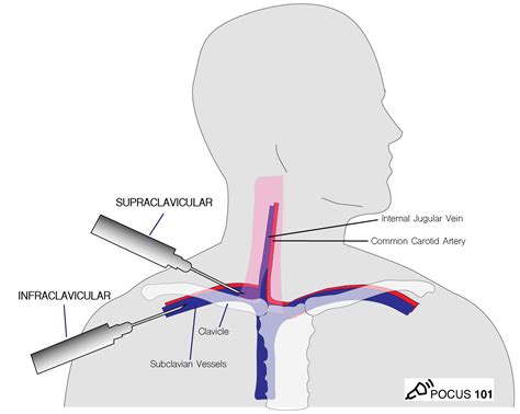 How to put in a central line