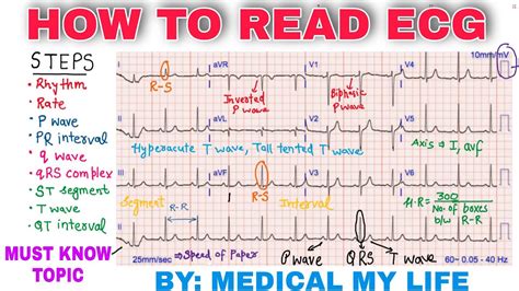 How to read an ekg. In a normal lead one the entire action of the heartbeat is recorded in a series of waves that begin with the right atria. It is comprised of one whole beat of the heart, from rest to contraction to rest. The first thing you see in a healthy, normal heartbeat is the P wave. Its the little hump that begins the complex. 