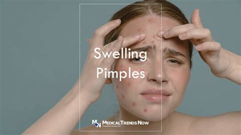 How to reduce inflammation in a pimple