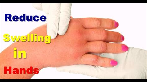 How to reduce swelling in my hands