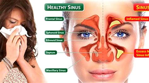 How to relieve sinus pressure in nose