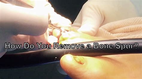 How to remove bone spurs in foot