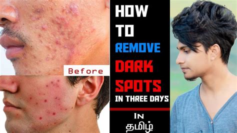How to remove dark spots in tamil