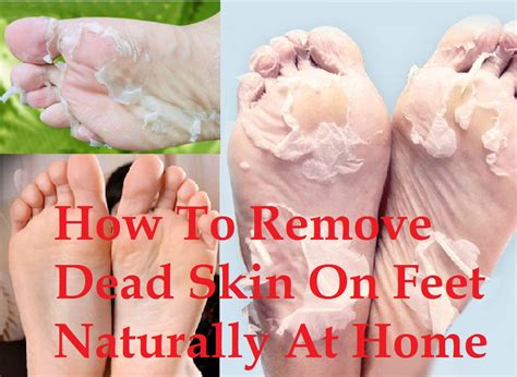 How to remove dead skin at my knees - Quora