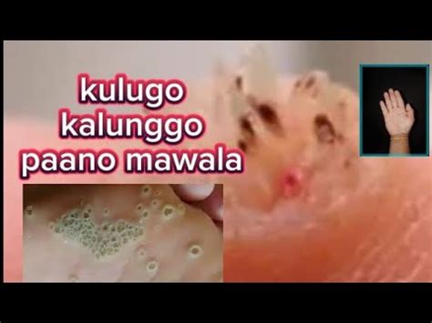 How to remove kulugo in hands