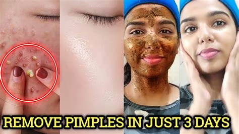 How to remove macham in face
