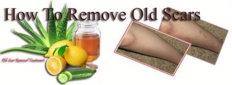 How to remove old scars on legs. .  <a href=https://dvizhenie-l.ru/lma2qbr/brooks-funeral...
