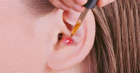 How to remove pimple in ear