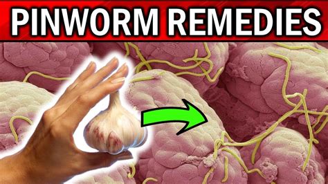 How to remove pinworms in humans
