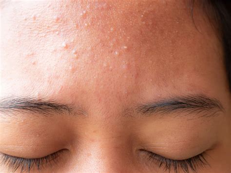 How to remove small pimples in forehead