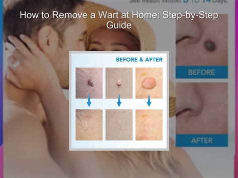 How to remove warts on face at home.  What Is Wart,Skin Tag and How Do Do...
