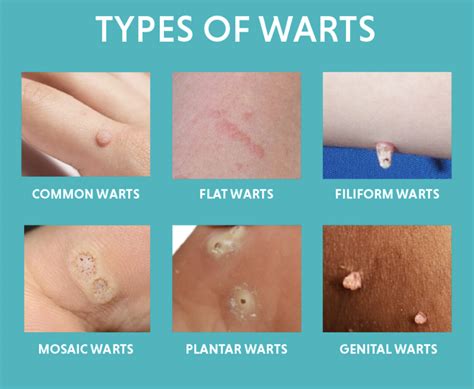 How to remove warts on hand.  Read on to learn what causes warts, and how to...
