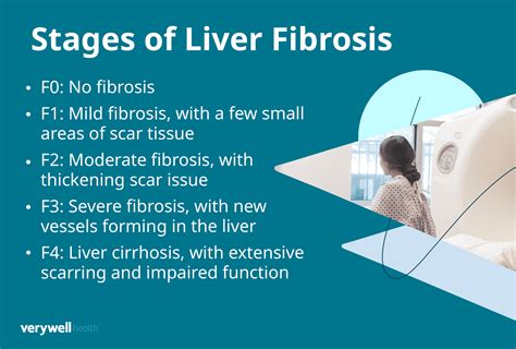 How to reverse liver fibrosis stage 2.  For alcohol-related liver dise...