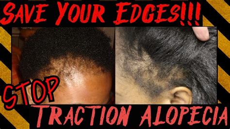 How to reverse traction alopecia manual a step by step guide for growing back your hair. - The var implementation handbook chapter 15 risk measures and their applications in asset management.