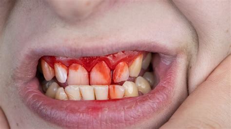 How to soothe cuts in mouth