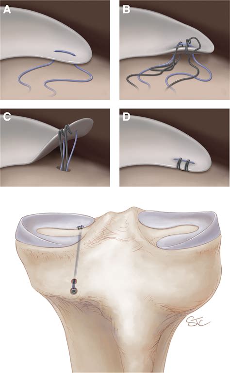 How to stop a stitch