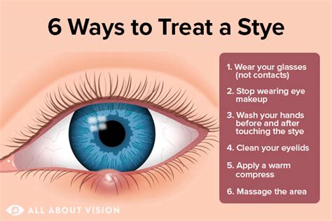 How to stop a stye
