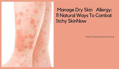 How to stop allergy itching