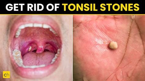 How to stop getting tonsil stones