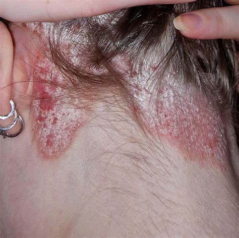 How to stop psoriasis from spreading