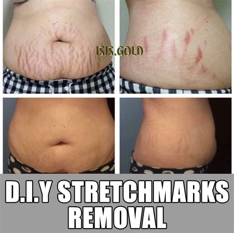How to stop stretch marks getting worse