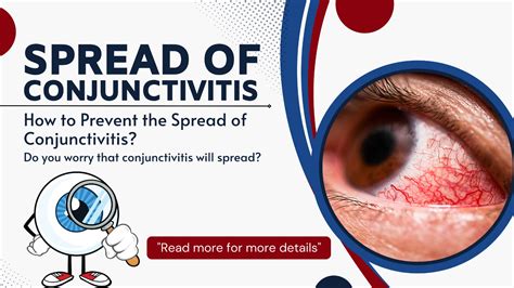 How to stop the spread of conjunctivitis