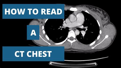 How to systematically read a CT chest YouTube