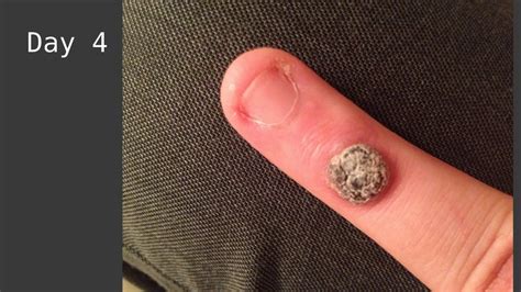 Blisters appear about 24 hours after the procedure. the wart It