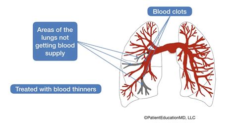How to treat clot in lung