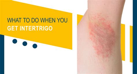 How to treat intertrigo in armpit