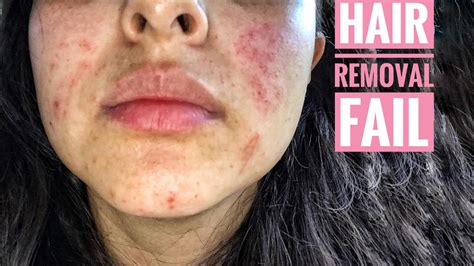 How to treat nair burn. Using salves, balms, moisturizers, or herbs like aloe on sunburned lips can help heal them and provide relief from pain or dryness. Keep in mind that if the sunburn causes broken skin or an ... 
