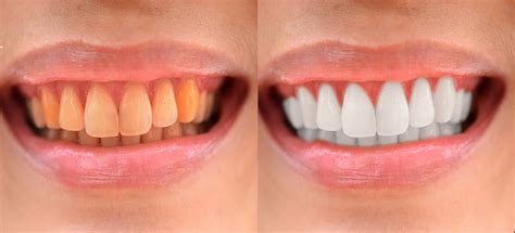 How to whiten teeth in photoshop. The simplest, easiest, and fastest way How to Whiten Teeth in Photoshop! In this lesson, learn how to accurately and realistically whiten yellow teeth, using... 