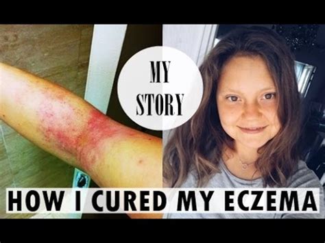 Read Online How I Cured My 10 Years Eczema In Just 5 Days With 3 Simple Steps Skin Care Eczema Cure Get Rid Of Eczema Forever Easy And Natural Eczema Treatment Eczema Remedies Stop Eczema Forever By Dan Garani