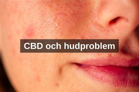 Hudproblem vad