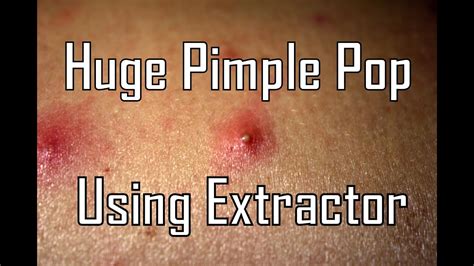 January 4, 2017. YouTube/ViralHog. This year is already proving to be a good one—for fans of pimple popping and cyst extracting videos, at least. The YouTube channel ViralHog just uploaded a ...