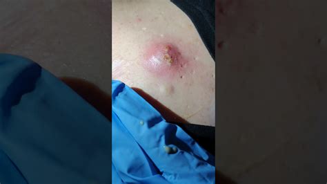 Huge boil burst. Symptoms. Epidermoid cyst signs and symptoms include: A small, round bump under the skin, often on the face, neck or trunk. A tiny blackhead plugging the central opening of the cyst. A thick, smelly, cheesy substance that leaks from the cyst. An inflamed or infected bump. 